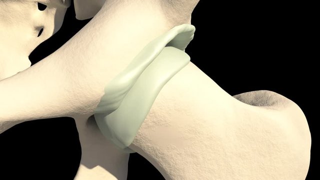 Acetabular Labral Lesion