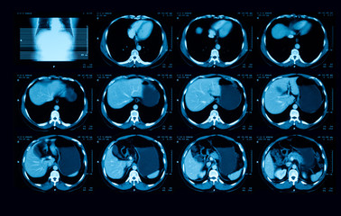 Computed tomography (CT scan) of upper abdomen with contrast media, a case of liver abscess