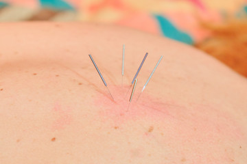 Traditional Chinese acupuncture needles on patient back. Woman with Caucasian skin undergoing acupuncture treatment  - close up.