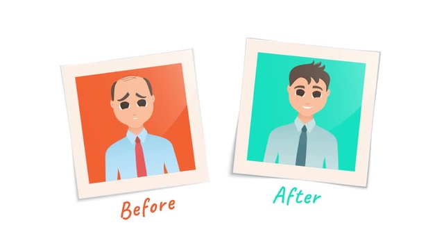 Man before and after hair transplantation treatment. Cartoon animation of two pictures. Male hair loss motion design graphics. Beauty medical transformation concept. 