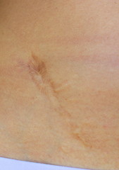 Small scar after appendicitis surgery. Fragment of the body of a man with a scar.