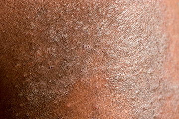 Selective focus of psoriasis,autoimmune skin disease.