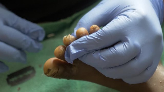 A close up shot of a African doctors hands as they remove a jigger parasite from a  African child's foot while using a safety pin.
