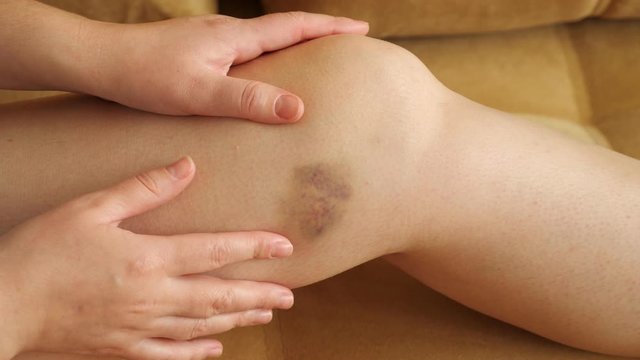 Woman examines and feels the bruise on her leg, close-up