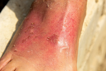 Fototapeta premium As a result of a skin burn, the woman's leg was swollen in the ankle region. Dermatitis, expressed by redness, peeling, and soreness after sunbathing. Sore foot bump.