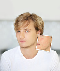Post-Acne Marks /Treating Acne Scars.Acne Scar Removal	