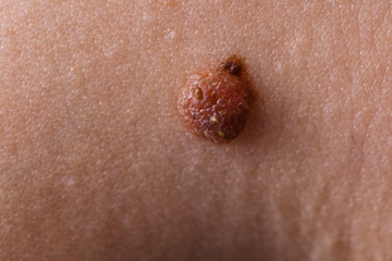 Closeup brown mole on caucasian woman skin.