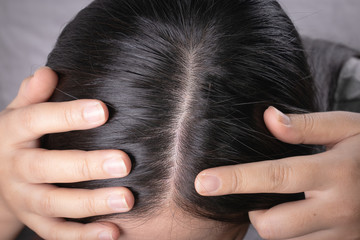 Young Asian women worry about problem hair loss,head bald,dandruff.hair loss problem and Hair treatment concept