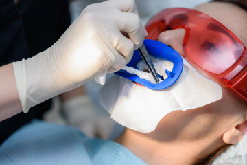 Preparing the oral cavity for whitening with an ultraviolet lamp. Close-up