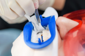 Preparing the oral cavity for whitening with an ultraviolet lamp. Close-up