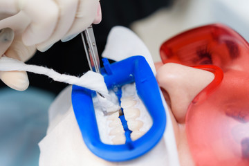 Preparing the oral cavity for whitening with an ultraviolet lamp. Close-up