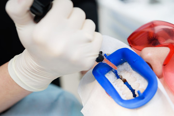 Preparing the oral cavity for whitening with an ultraviolet lamp. Close-up