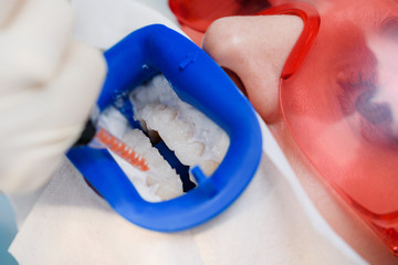 Preparing the oral cavity for whitening with an ultraviolet lamp. Close-up