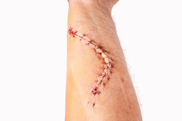 Surgery wound fix with staple on arm,isolated on white background.