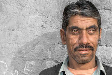 a smiling poor farmer in a village with crossed eyes or starbismus disease