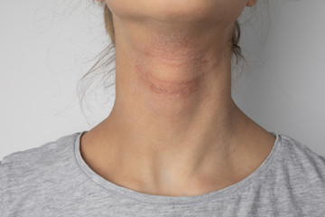 Allergic itchy skin on girl neck. Teen with rash dry skin on neck. Dermatological problem. Girl with atopic dermatitis. Allergy concept - obrazy, fototapety, plakaty