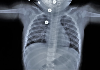 chest x-ray, pneumonia, emphysema, pulmonology, diagnosis of diseases