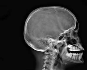 normal radiography of the skull in lateral projection in yellow medical diagnostics, traumatology and orthopedics, neurosurgery