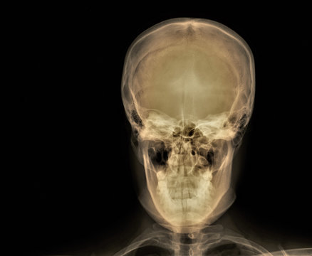 normal x-ray of the skull in direct projection, medical diagnostics, traumatology and orthopedics, neurosurgery