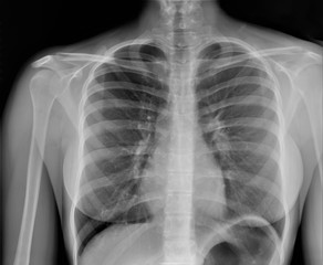 chest x-ray, pneumonia, emphysema, pulmonology, diagnosis of diseases