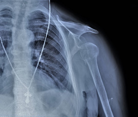x ray of the shoulder joint with dislocation of the head of the humerus
