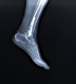 the x-rays of intramedullary osteosynthesis in the fracture of the tibia,implant