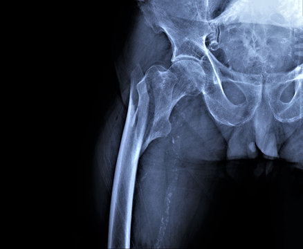  x-ray of hip joint with femoral neck fracture, traumatology and orthopedics