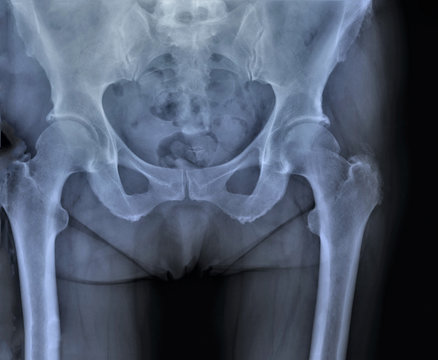 x-ray of pelvic bones and hip joints in direct projection, coxarthrosis, osteoporosis, medical research