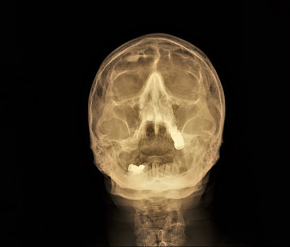 x ray of the paranasal sinuses of the skull, medical diagnosis