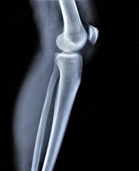 x ray of the knee joint , medical diagnostics, traumatology and orthopedics