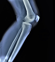 x ray of the knee joint , medical diagnostics, traumatology and orthopedics