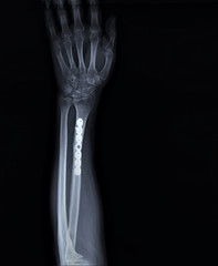 x-ray with osteosynthesis of the fracture of a radial bone plate with screws