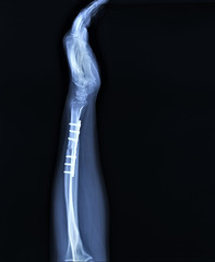 x-ray with osteosynthesis of the fracture of a radial bone plate with screws