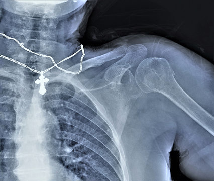 x-ray of the shoulder joint of an adult male, medical diagnosis, examination