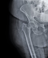 x-ray of hip joint with femoral neck fracture, traumatology and orthopedics