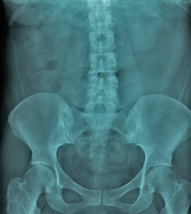 x-ray of the abdominal cavity and pelvis in direct projection, medical research