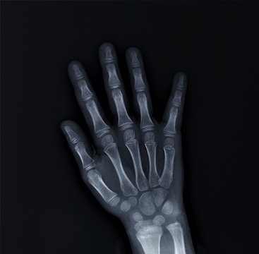 x-ray of hand bones, diagnosis of diseases