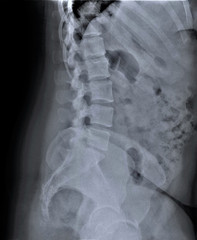 x ray of lumbar and sacral spine in lateral projection, medical diagnostics