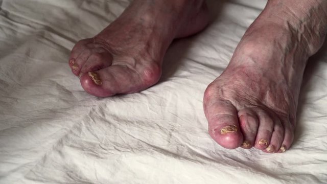 Closeup of a foot with damaged nails because of fungus. Elderly woman legs. Diabetis