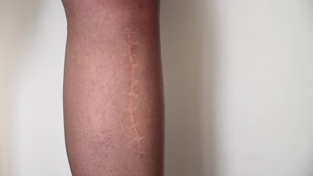 The scar on the leg. Bone fracture or tumor removal. Recovery