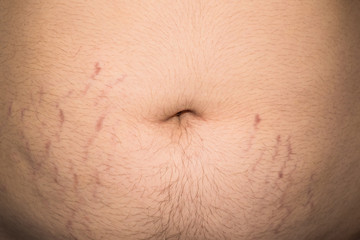 A man is overweight all over his body, on his stomach, chest, arms. Stretch marks on the abdomen in the process of losing weight.