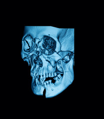 Computed tomography (CT scan) of facial bone, right obliqe view, showing  mutiple fractures of face bone © SutthaB