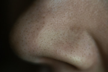 Black dots on the nose. Close up. Nose profile.