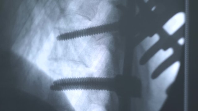 x-ray with bone fracture on a computer monitor 2