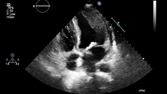High quality transesophageal ultrasound video in gray-scale mode.