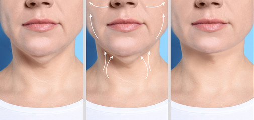 Mature woman before and after plastic surgery operation on blue background, closeup. Double chin...