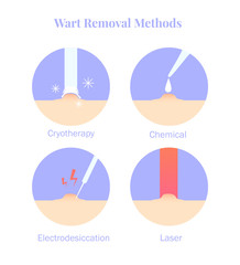 Infographics wart removal methods. Cryotherapy, Electrodesiccation, chemical and laser removal.