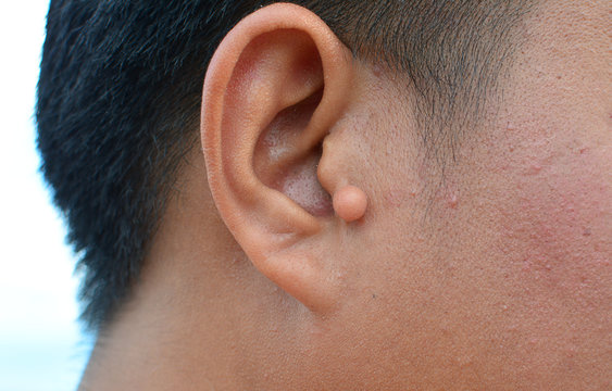 Scar Keloid ear ball shaped. hypertrophic scar on man ear. Can used for healthcare concepts.