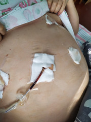 Condition after laparoscopic cholecystectomy for gallstone disease (removal of the gallbladder)....