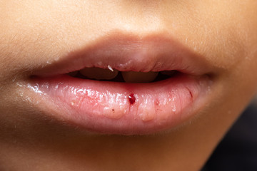 Chapped lips of a child with obvious signs of dehydration